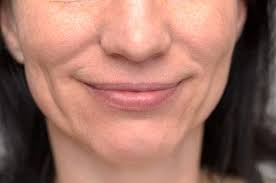 Laugh Line Softening