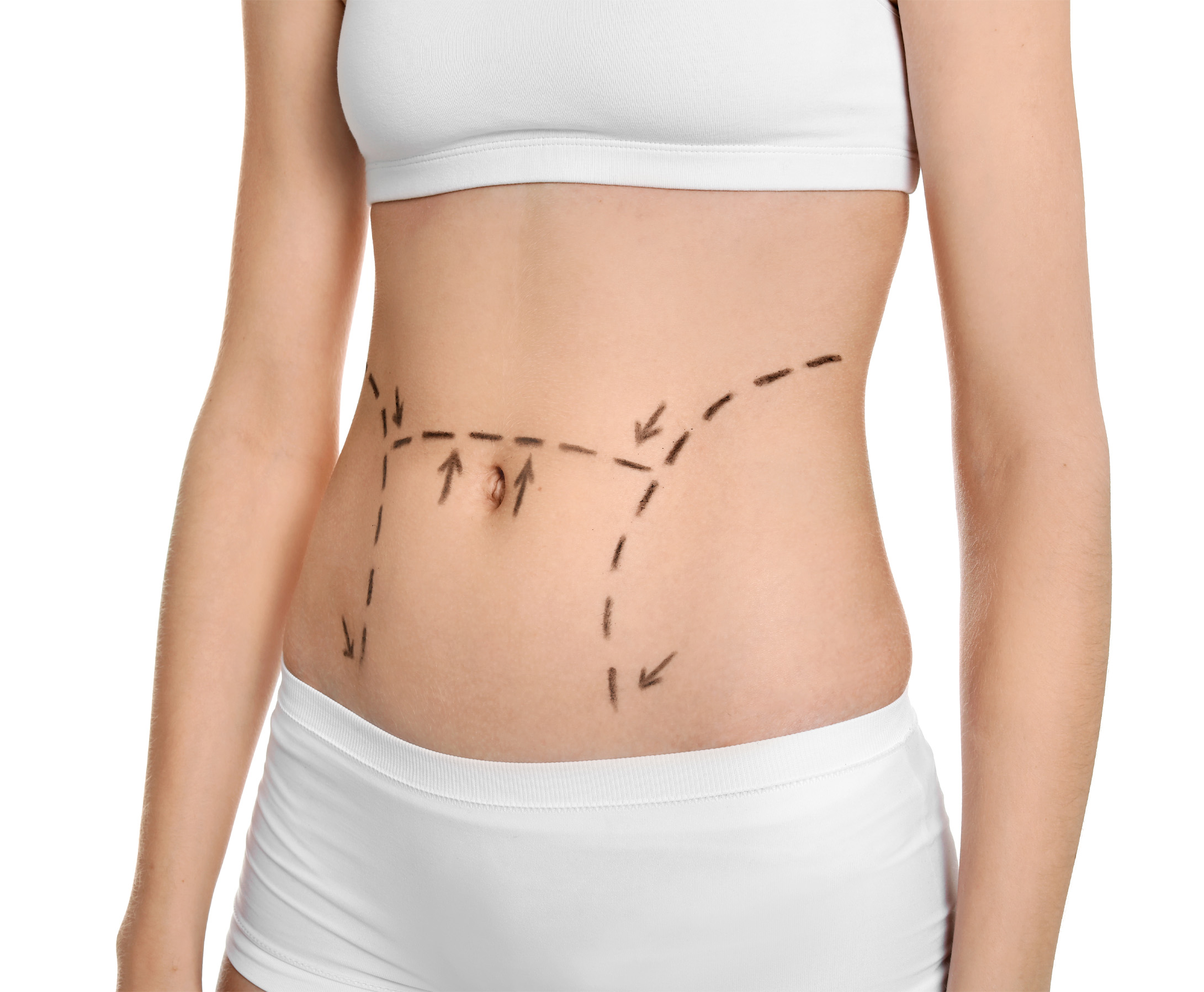 Tummy Tuck
